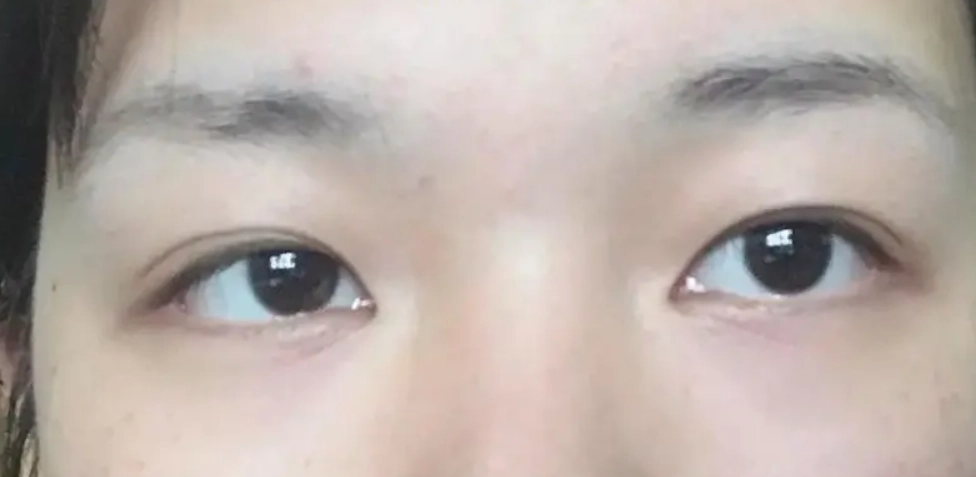 眼睛一高一低原因全解析：從常見成因到改善方法