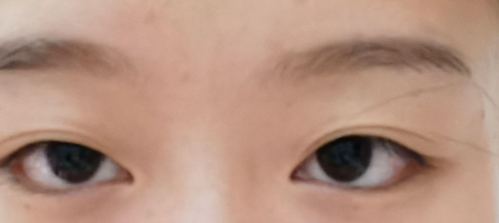 眼睛不對稱原因