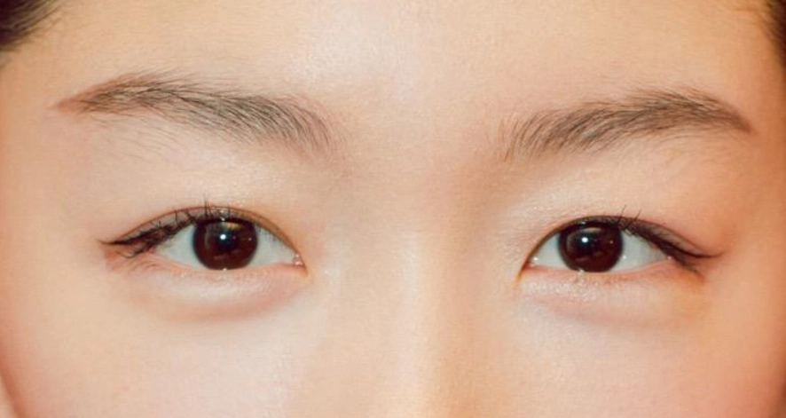眼睛不對稱