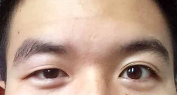 眼睛一大一小原因