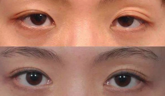 提眼肌手術恢復時間