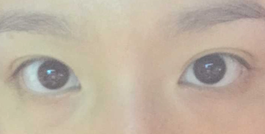 眼睛大小不對稱改善