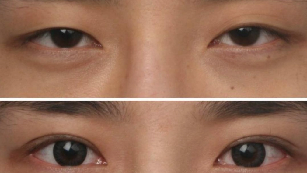 左右眼不對稱原因