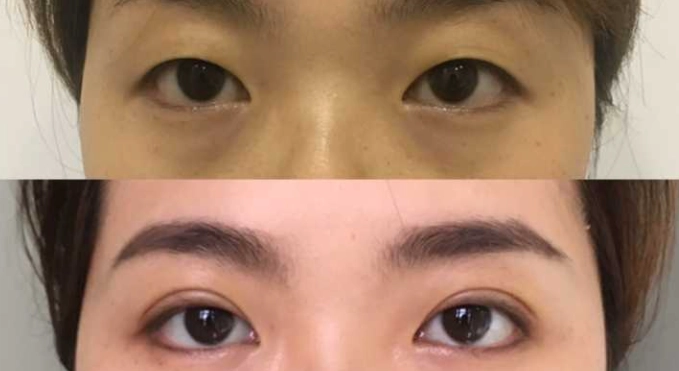 眼睛不一樣高怎麼辦？原因、檢測與改善方法全攻略