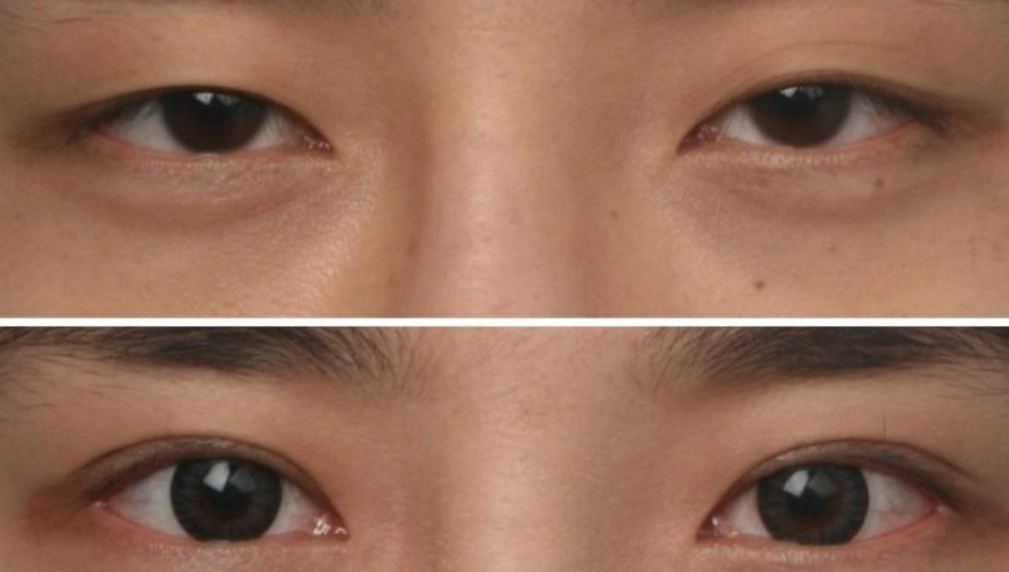 拍照眼睛不對稱怎麼辦？專家教你改善方法與自拍技巧