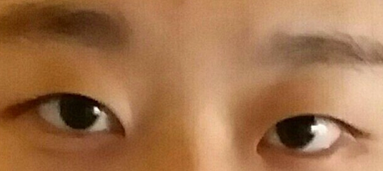眼眶不對稱矯正