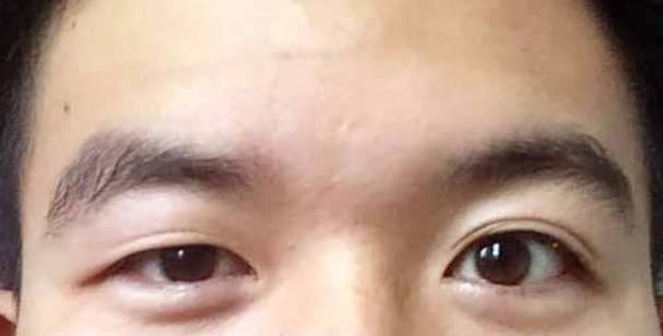 大小眼手術費用