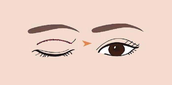 香港眼睑提肌手术