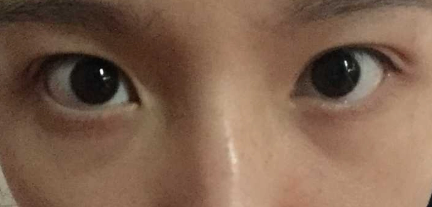 眼睛不對稱治療