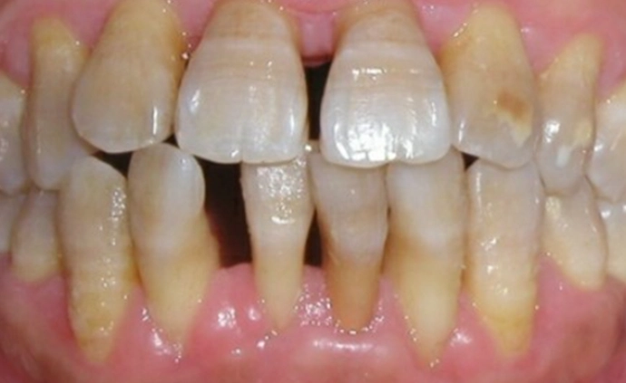 牙周病治療抗生素