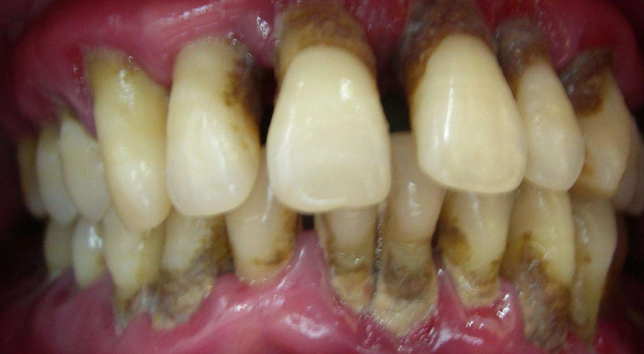 牙周病抗生素治療全攻略：什麼情況需要吃？吃對了嗎？