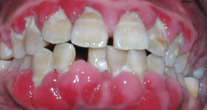 抗生素治療牙周病