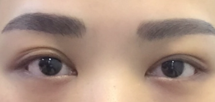 眼睛不對稱矯正