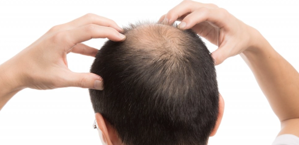 雄性禿抽血檢查醫院