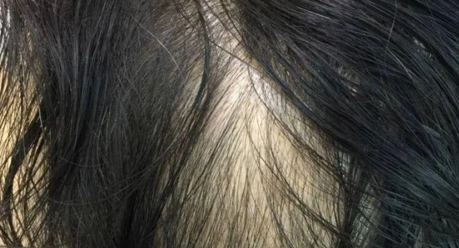 頭髮稀疏看什麼科？皮膚科、家醫科還是內分泌科？完整就醫指南