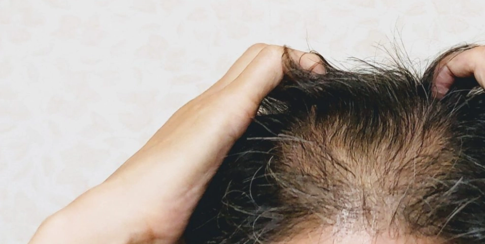 自體免疫疾病脫髮