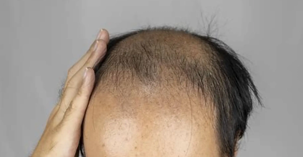 雄性禿抽血檢查醫院