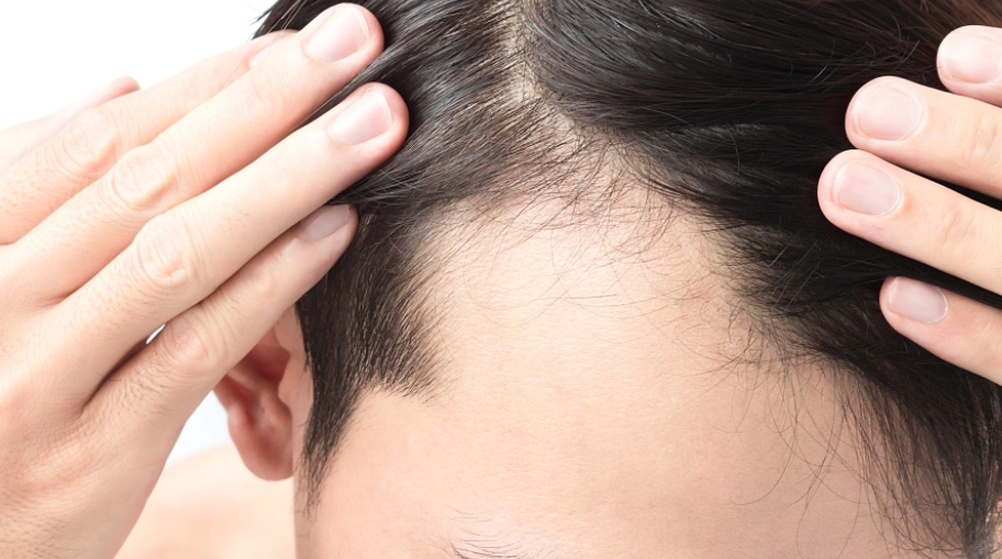 頭髮稀疏原因