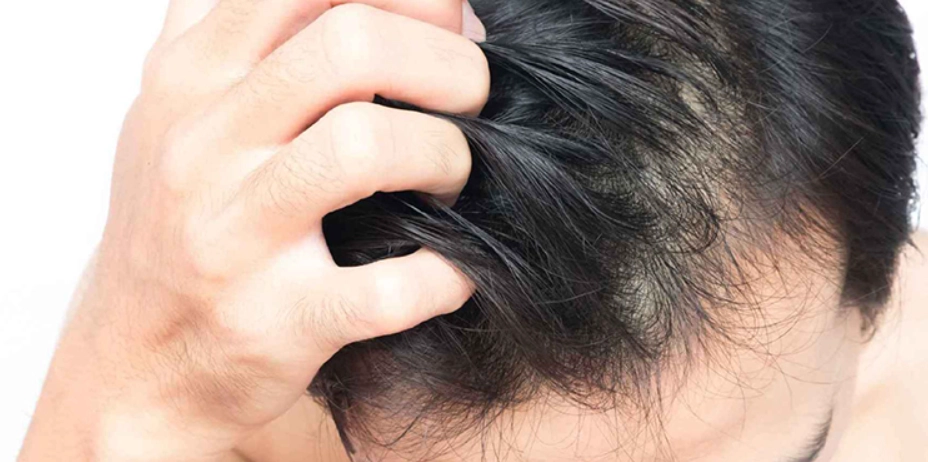 掉髮原因