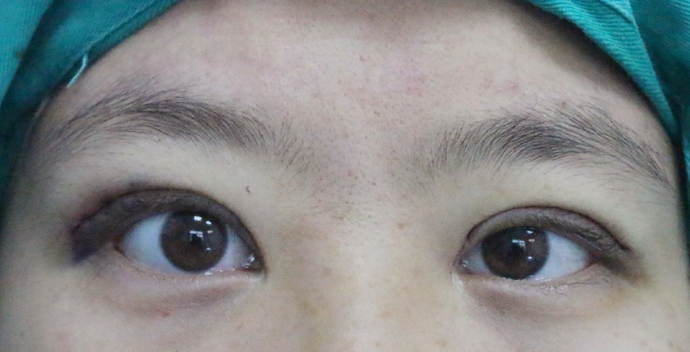 眼睛不对称改善