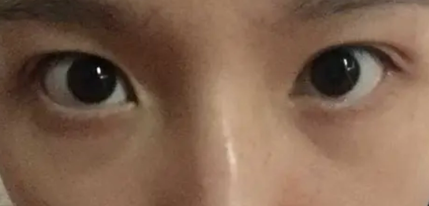 眼睛不对称改善