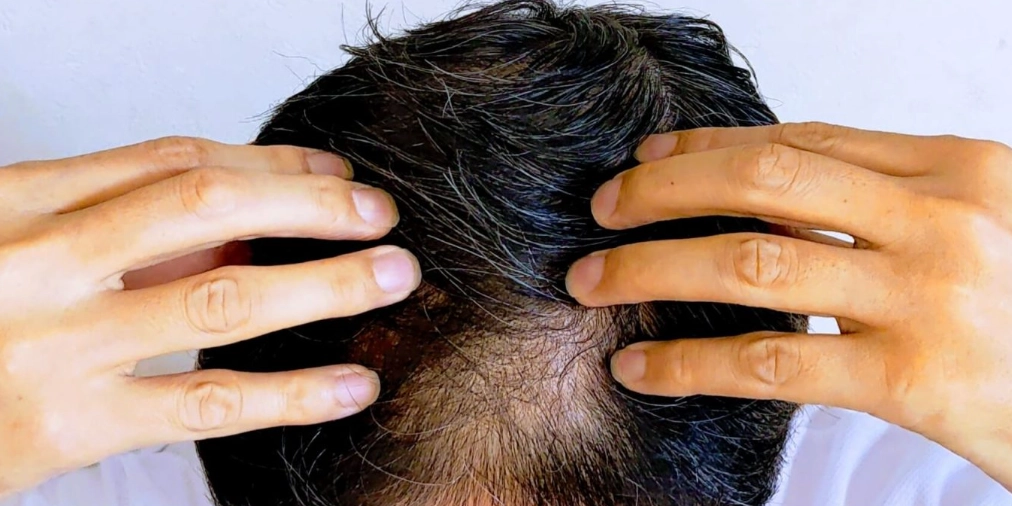 雄性禿抽血檢查：精準診斷落髮原因，制定有效治療方案的關鍵