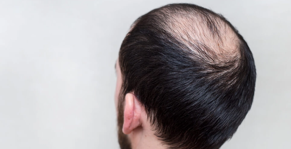 掉頭髮要看哪一科