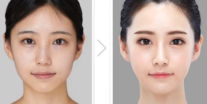 臉部不對稱矯正