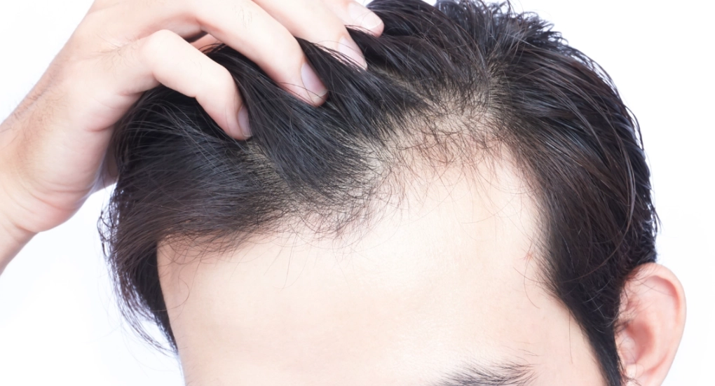 男性掉髮