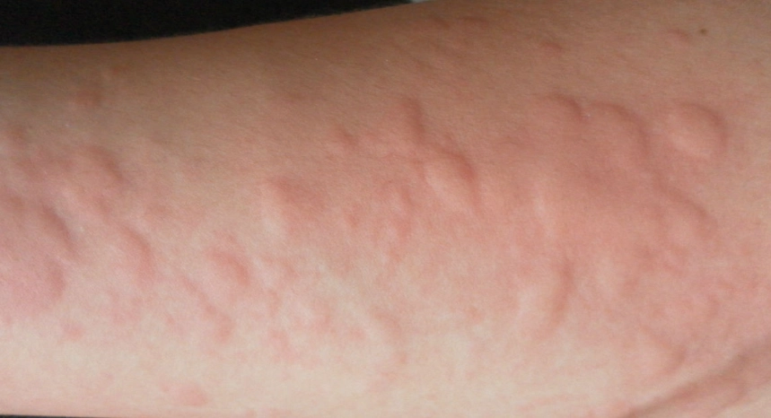 蕁麻疹夜間發作原因