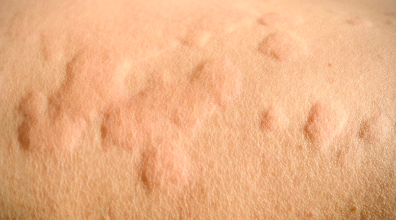 蕁麻疹止癢方法