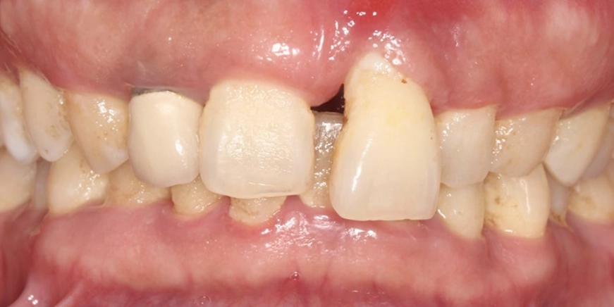 牙齦萎縮酸症狀 牙齦萎縮酸症狀