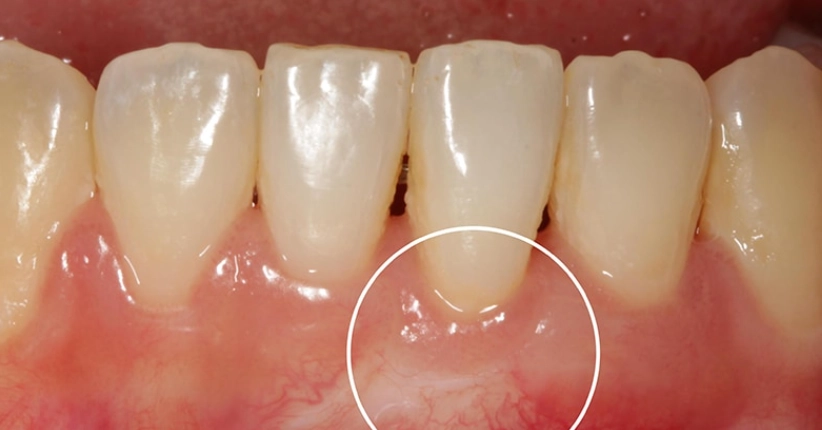 牙齦萎縮酸症狀 牙齦萎縮酸症狀