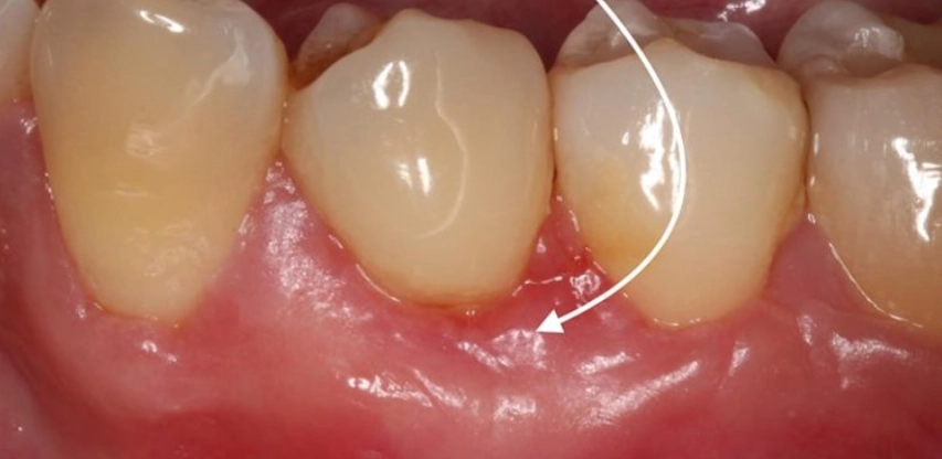 牙齦萎縮原因 牙齦萎縮原因