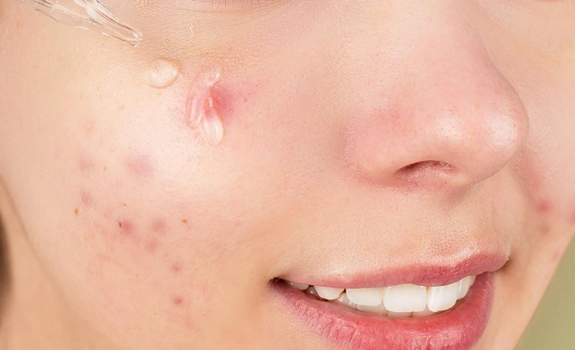 鼻水止不住 鼻水止不住