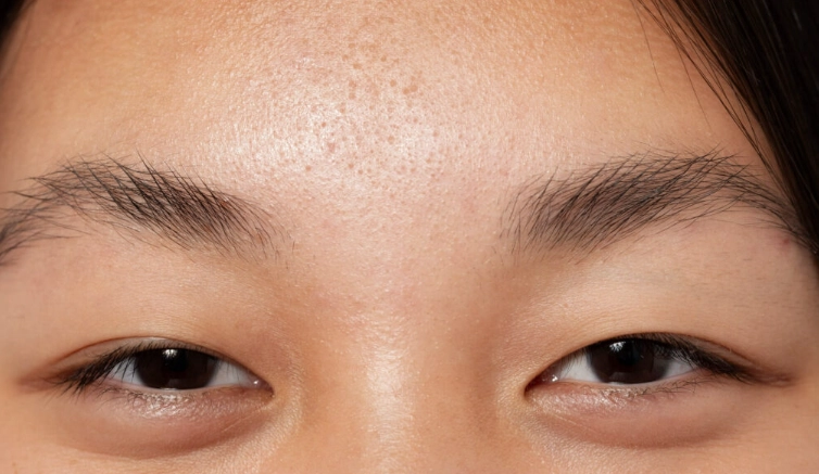 眼瞼下垂手術價格