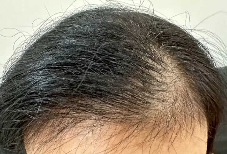 女性禿頭門診推薦