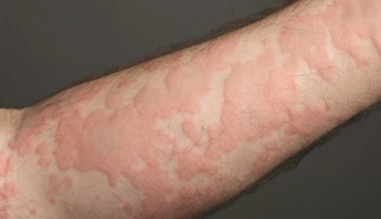 蕁麻疹發作區域