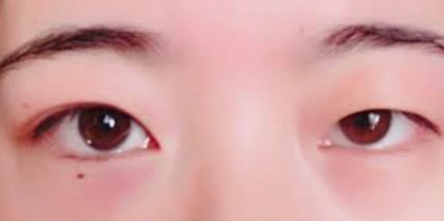 右眼大左眼小怎麼辦？女性眼睛不對稱原因與改善方法全攻略