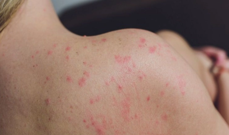 蕁麻疹發作區域