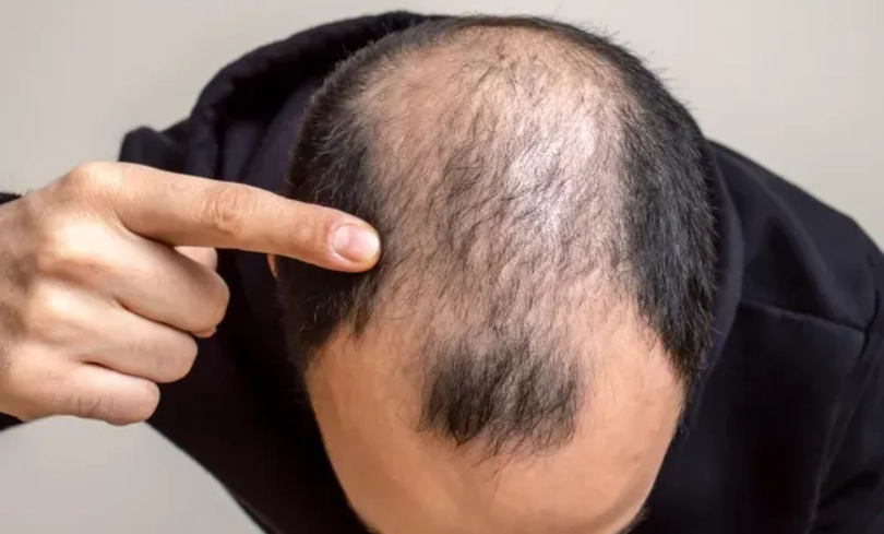 掉髮原因