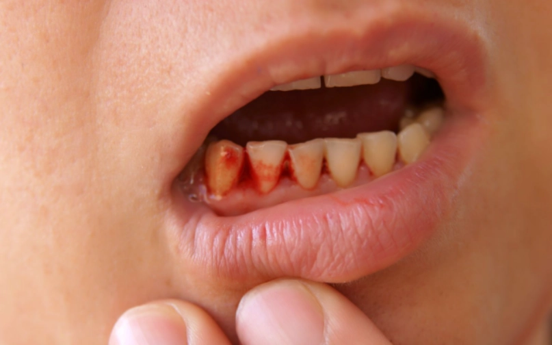 牙間刷使用技巧 牙間刷使用技巧