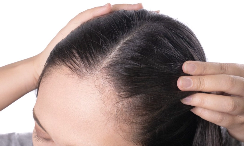 掉髮中醫 掉髮中醫