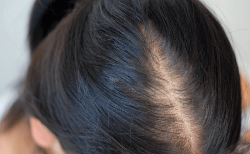 掉髮中醫 掉髮中醫