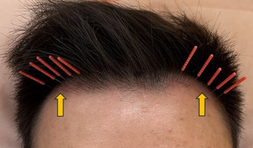 中醫生髮治療 中醫生髮治療