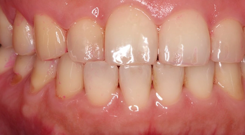 牙菌斑形成時間