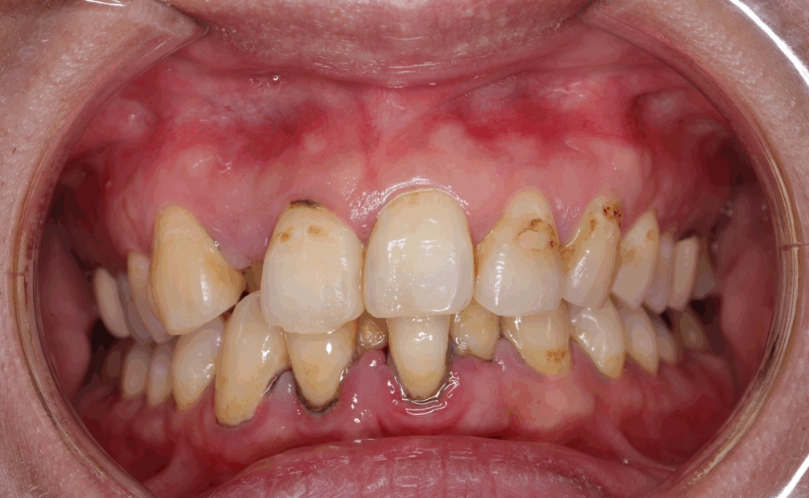 牙菌斑形成時間