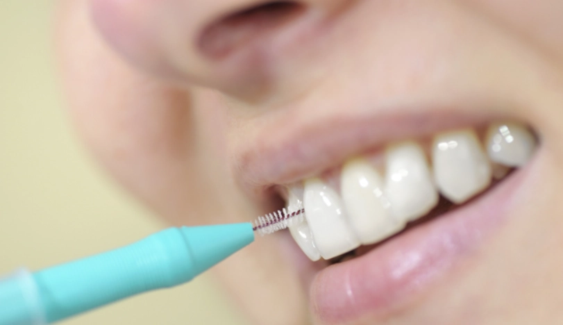 牙菌斑清除方法