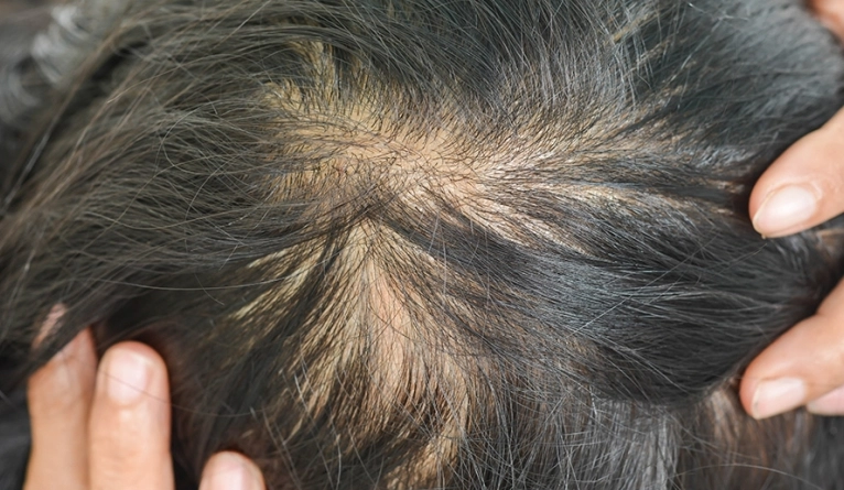 頭髮變細怎麼辦