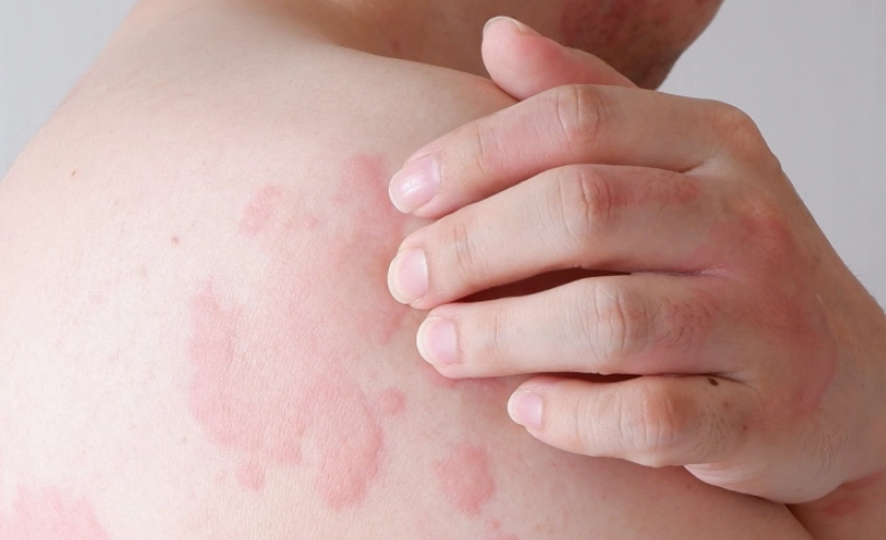 蕁麻疹不會癢
